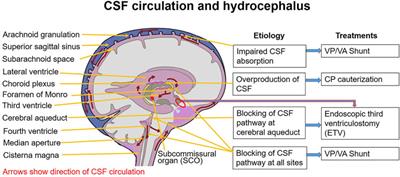 Molecular Mechanisms and Risk Factors for the Pathogenesis of Hydrocephalus